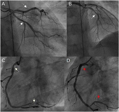 Case report: A rare manifestation of vasospasm induced myocardial infarction with ST-segment elevation in a young male patient